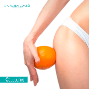 7-Celulitis-Dr-Cortes-ingles