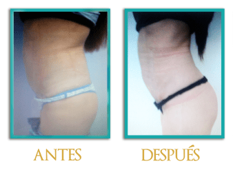 abdominoplastia-2