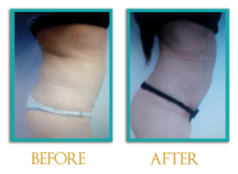 abdominoplastia-2a-ingles