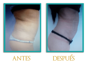 abdominoplastia-2a