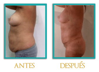 abdominoplastia-3