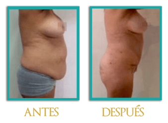 abdominoplastia-4