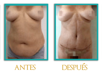 abdominoplastia-5