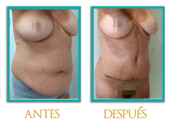 abdominoplastia-6