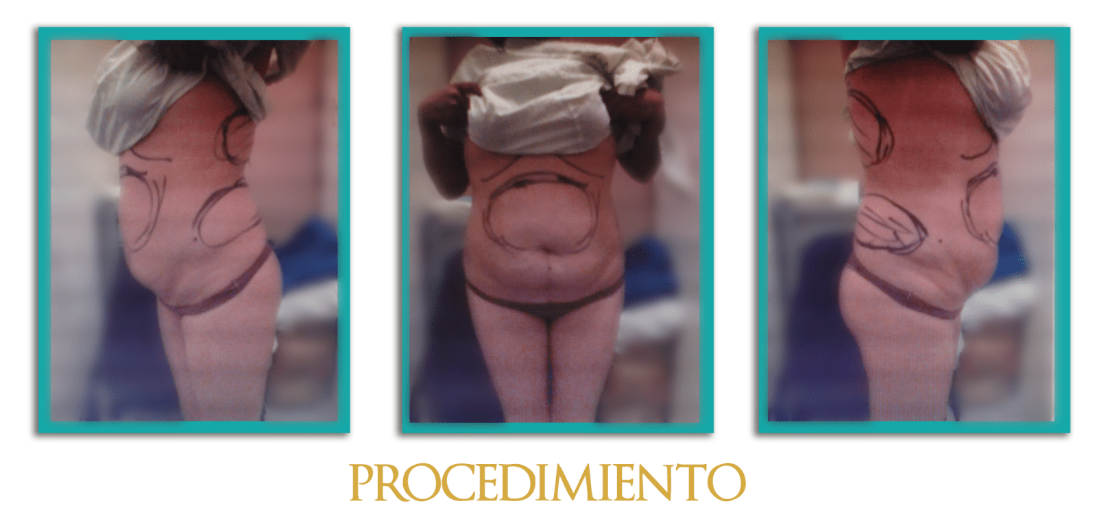 Abdominoplastia-7
