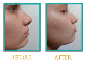 acido-hialuronco-3-ingles