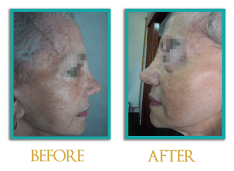 acido-hialuronco-4-ingles