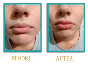 acido-hialuronico-2-ingles