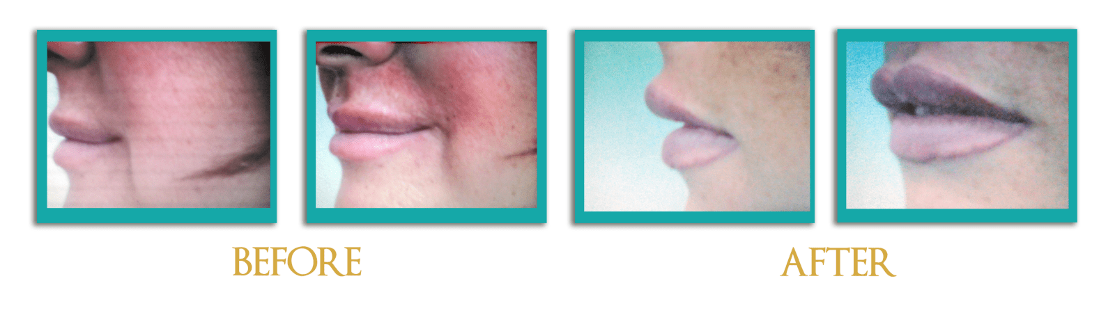 acido-hialuronico-6-ingles