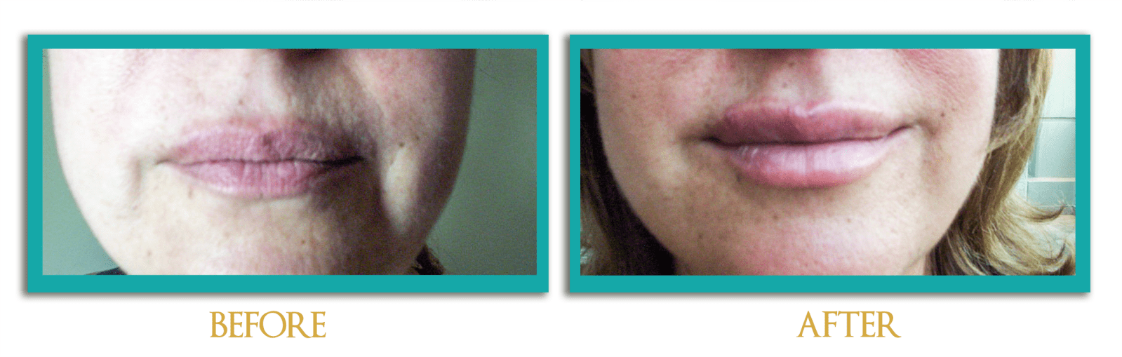 Acido-Hialuronico-ingles