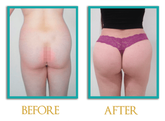 Aumento-de-gluteos-2-ingles