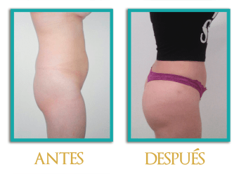 Aumento-de-gluteos-3