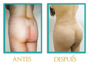 Aumento-de-gluteos