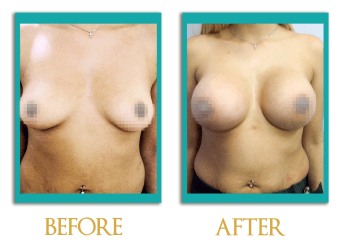 Aumento-mamario-1-ingles