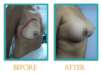 Aumento-mamario-2-ingles