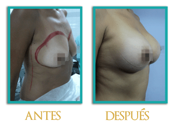 Aumento-mamario-2