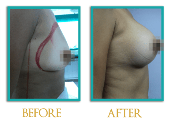 Aumento-mamario-3-ingles