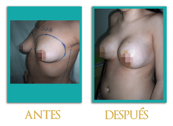 Aumento-mamario-5