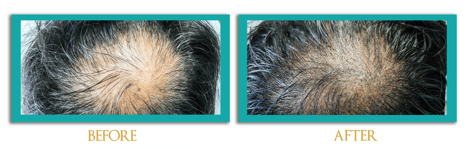 dermopigmentacion1-ingles