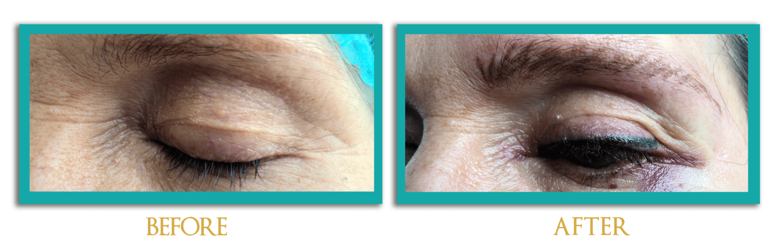 dermopigmentacion2-ingles