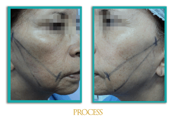 Hilos-tensores-4-ingles