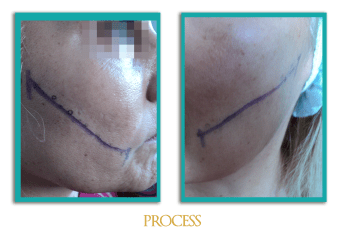 Hilos-tensores-6-ingles