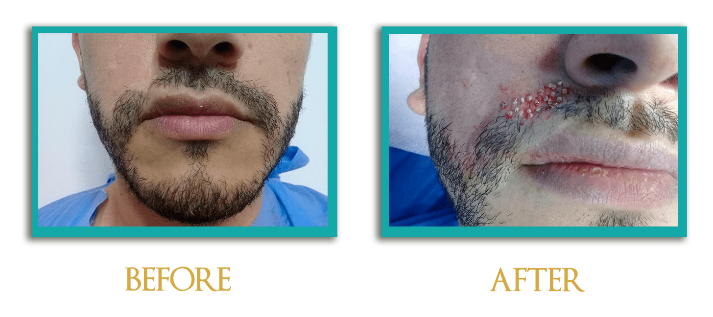 implante-barba-1-ingles