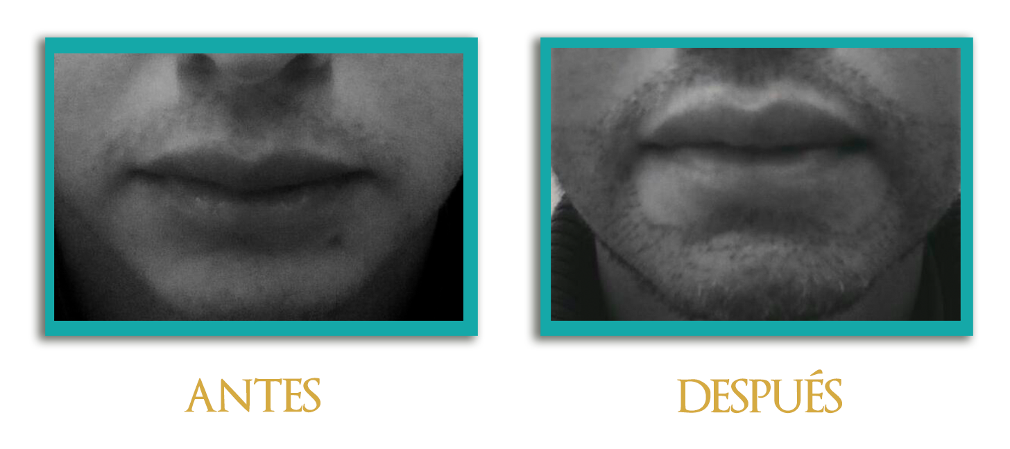 implante-barba-3