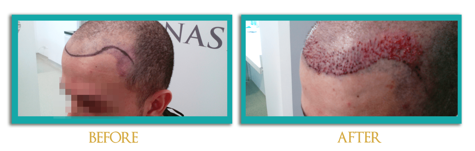 implante-cabello-1-ingles