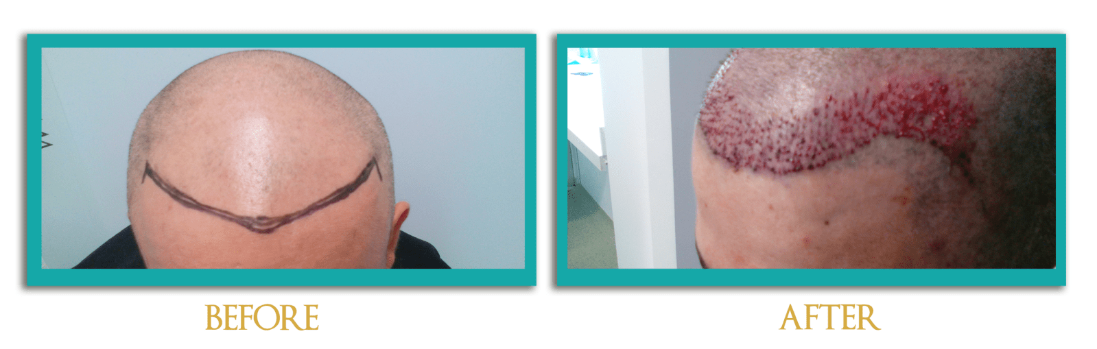 implante-cabello-2-ingles