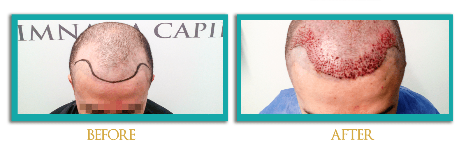 implante-cabello-ingles