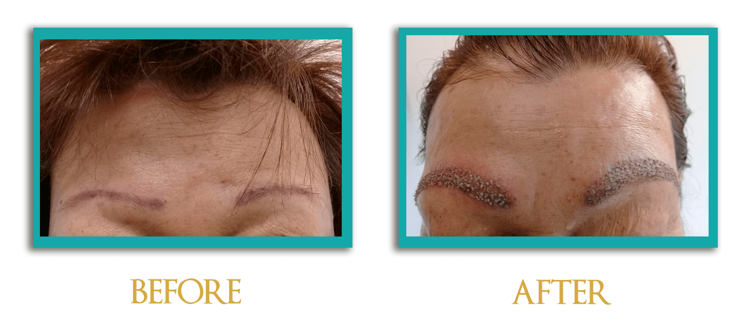 implante-cejas-1-ingles