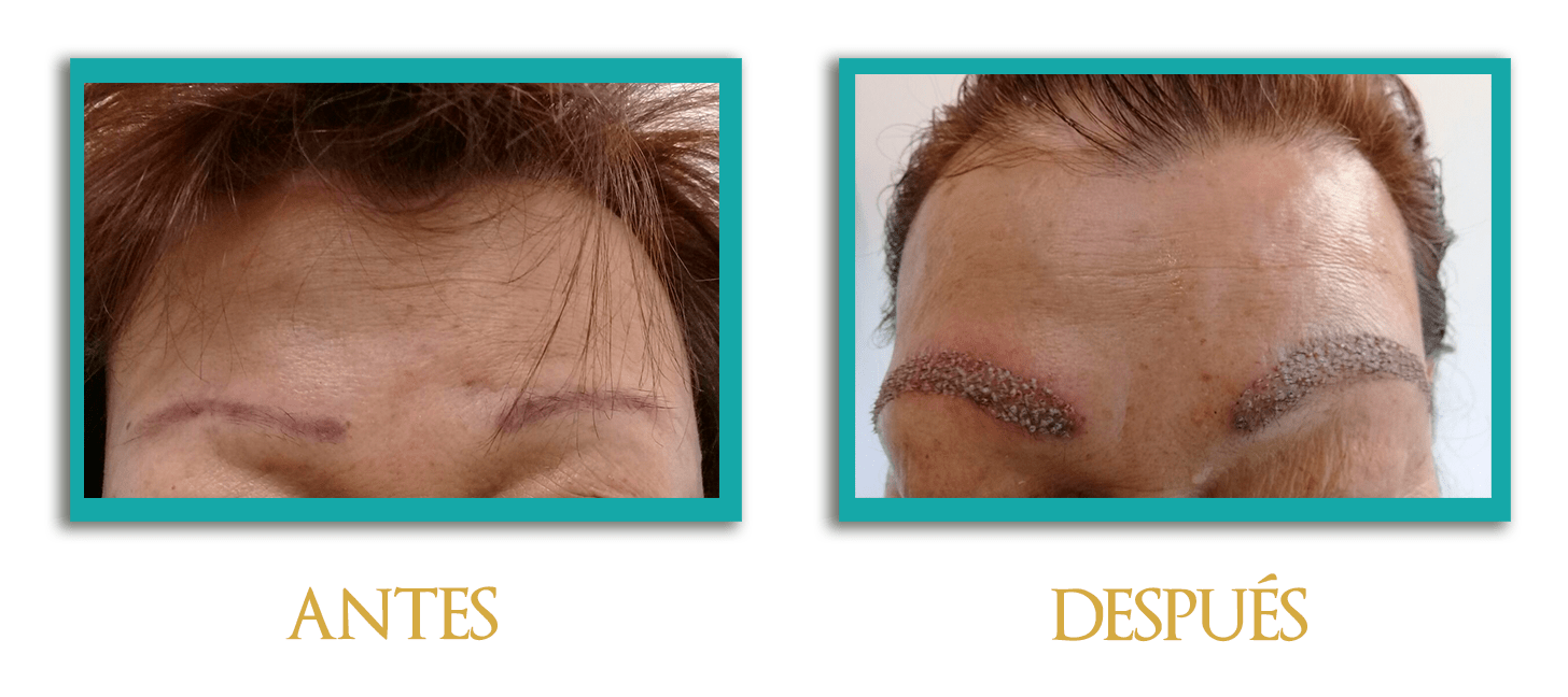 implante-cejas-1