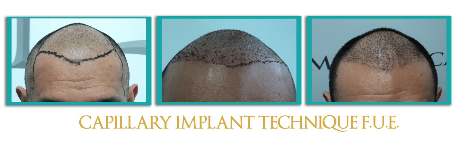 implante-FUE-ingles
