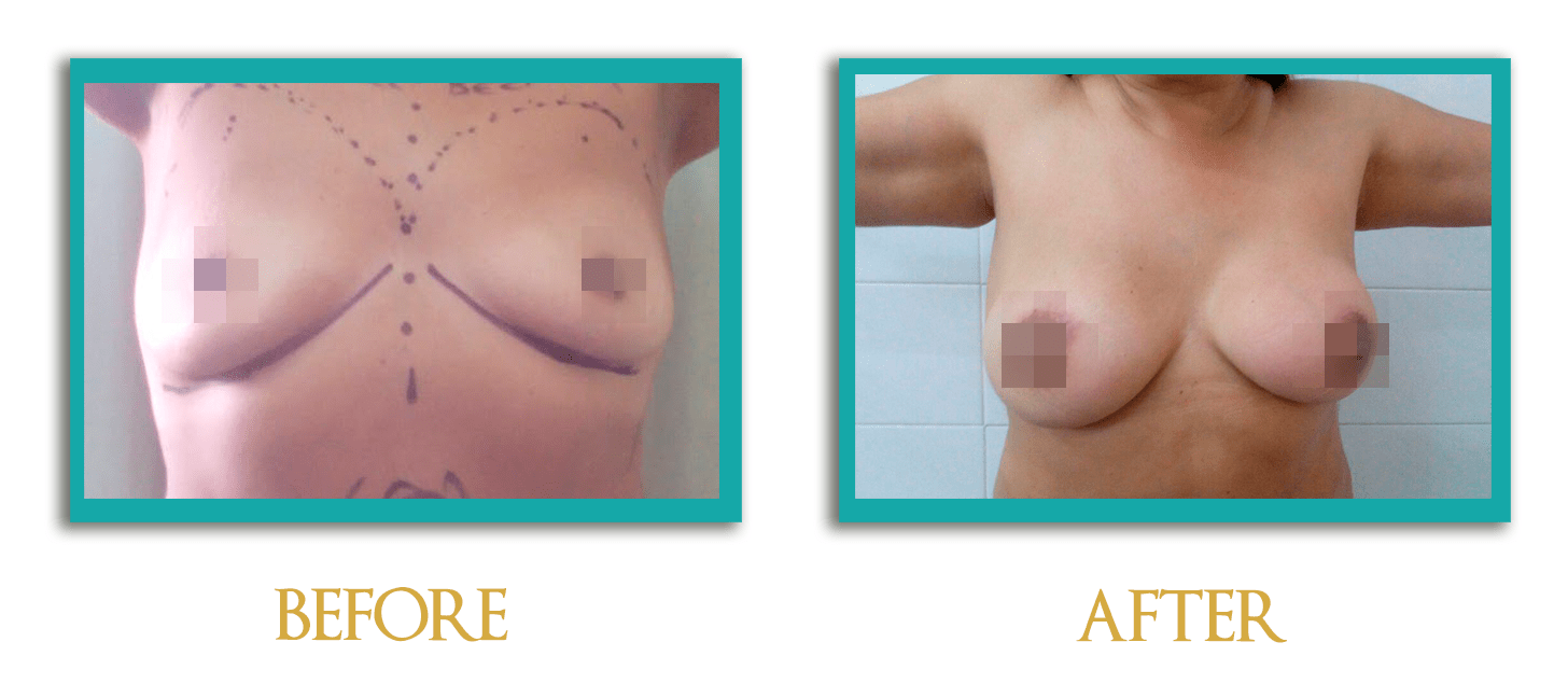 implante-mamas-ingles