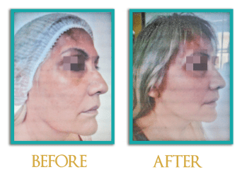 lifting-facial-y-cuello-1-ingles