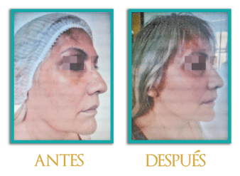 lifting-facial-y-cuello-1