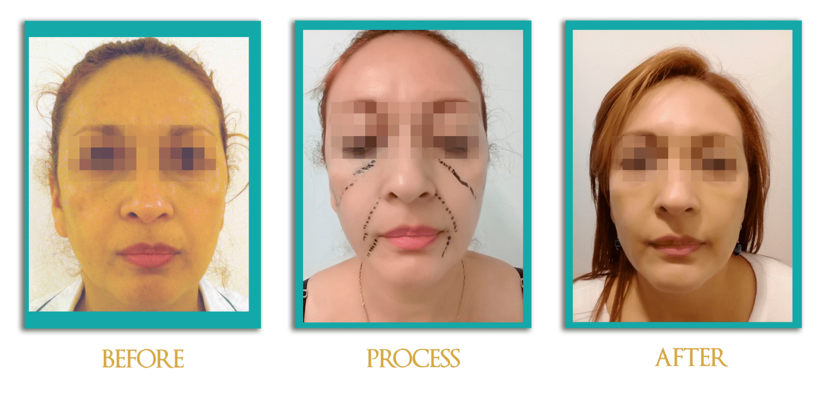 lipofilling-facial-ingles