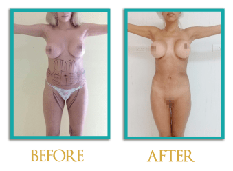 Lipomodelado-2-ingles