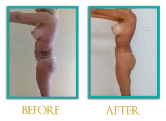 Lipomodelado-4-ingles