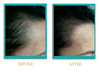 Micropigmentacion-cabeza-1-ingles