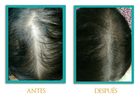 Micropigmentacion-cabeza