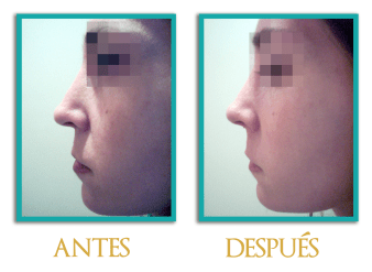 Rinoplastia-1