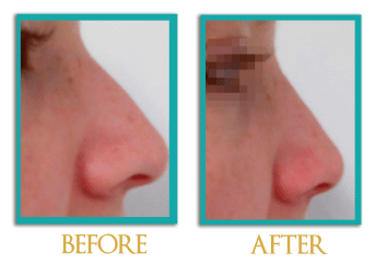 Rinoplastia-1a-ingles