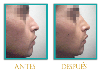 Rinoplastia-2