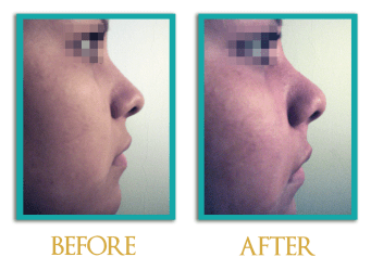 Rinoplastia-3-ingles