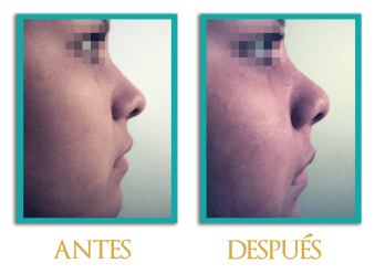 Rinoplastia-3