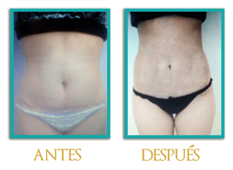 abdominoplastia-1