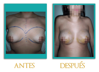 Aumento-mamario-4