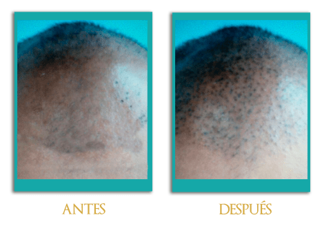 Micropigmentacion-cabeza-3